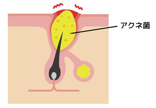 赤にきび　丘疹（きゅうしん）