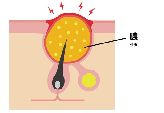 黄色にきび　膿疱（のうほう）