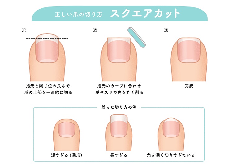 巻き爪・陥入爪（かんにゅうそう）